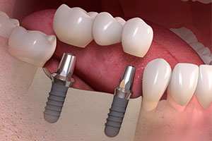 Are you tired of dealing with missing teeth or the hassle of removable dentures? Dental implants offer a revolutionary solution for restoring your smile and oral health.