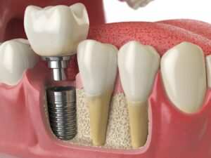 Dental Implants: Anchoring Your Confidence