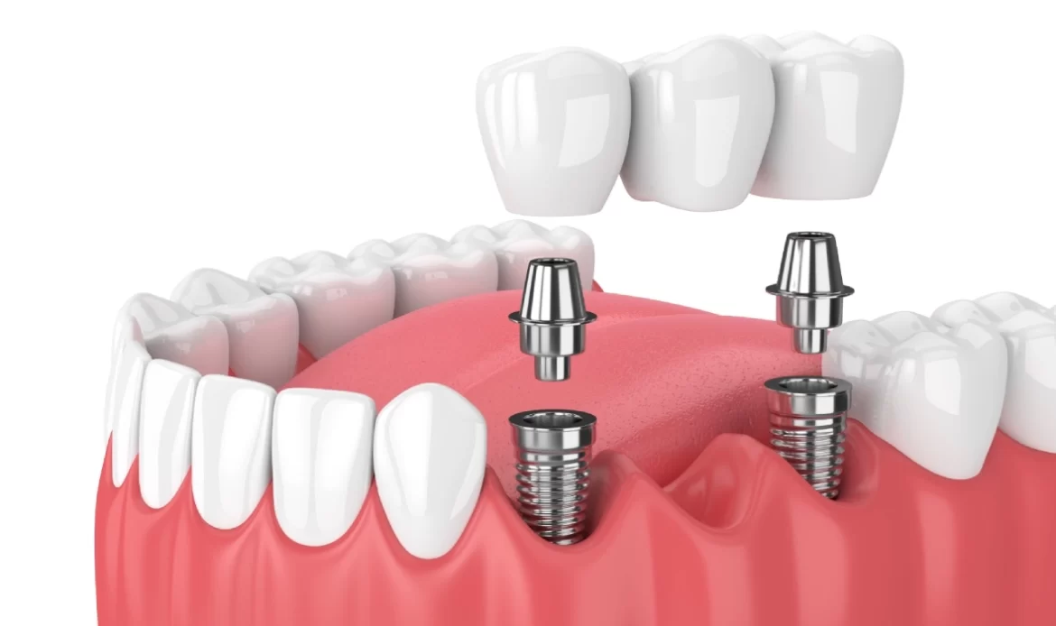 All on Six implant, 6 implant ile uygulanır.
