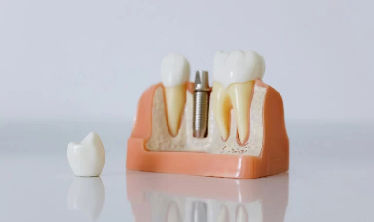 Eş zamanlı dental implant uygulaması ile kemik kaybı azaltılır.