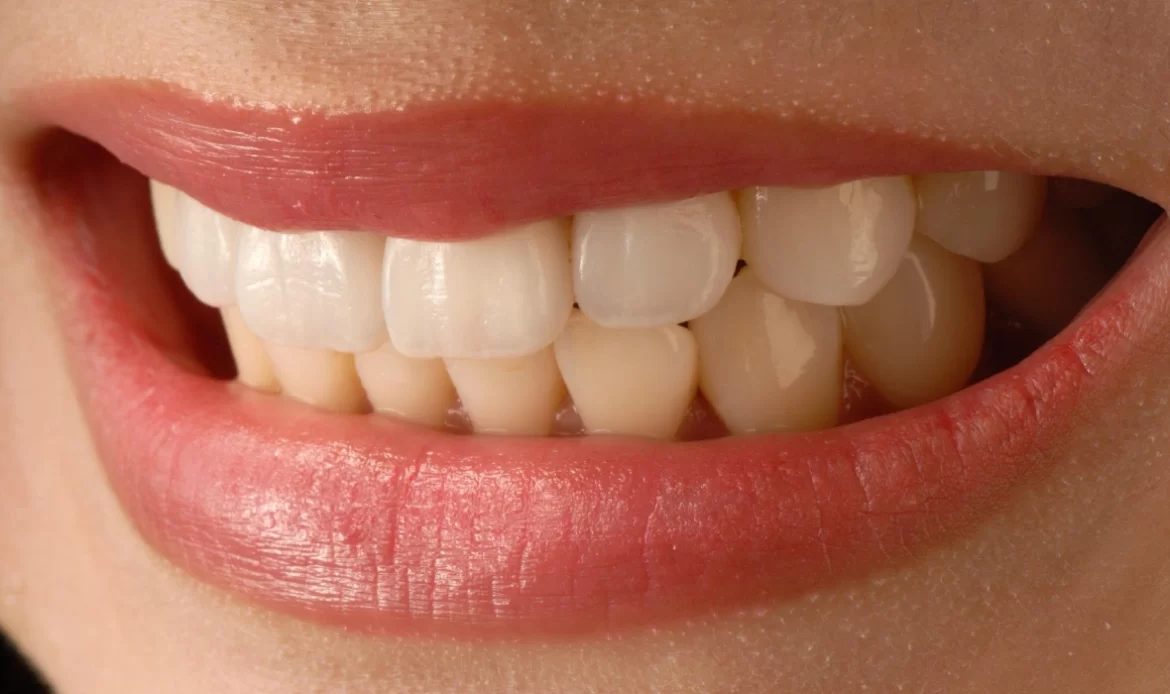 Veneer kron, gülüş tasarımında tercih edilir.