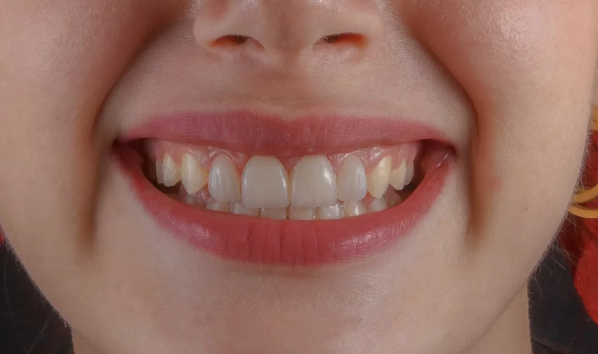 Gülerken diş eti görünmesi "gummy smile" olarak adlandırılır.