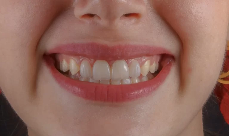 Gülerken diş eti görünmesi "gummy smile" olarak adlandırılır.