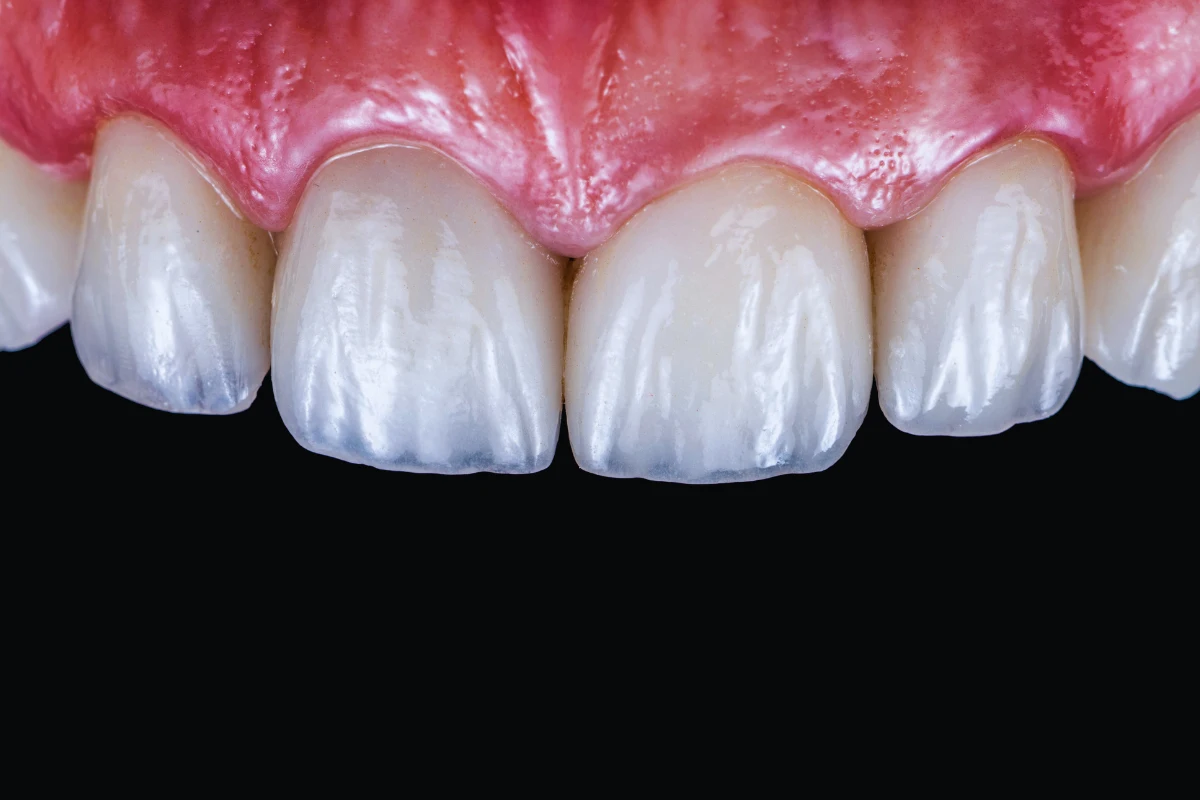 emax kron oldukça dayanıklı ve doğal olması ile bilinir.