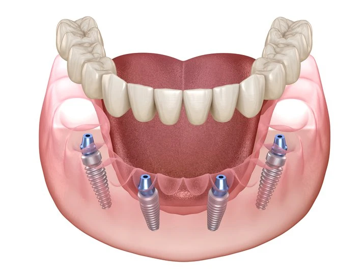 all on modern bir implant tedavisidir.