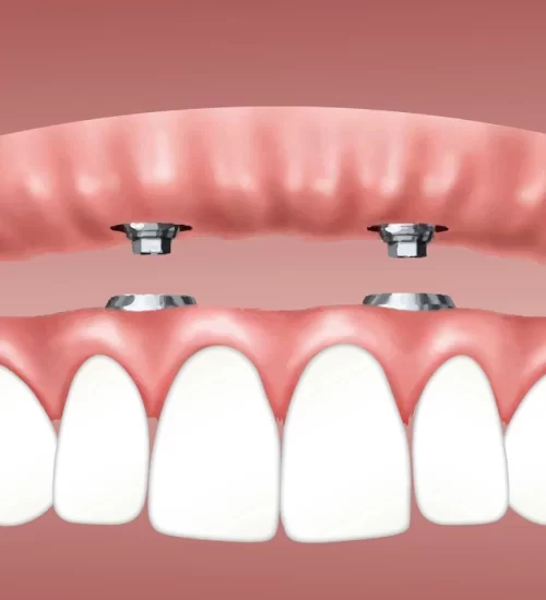 1 günde diş implantı yapılabilir.