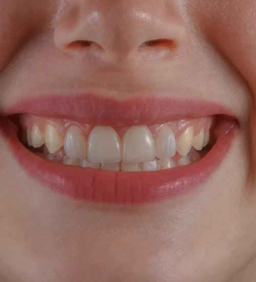 Gülerken diş eti görünmesi "gummy smile" olarak adlandırılır.