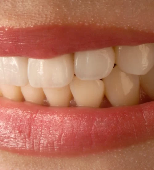 Veneer kron, gülüş tasarımında tercih edilir.